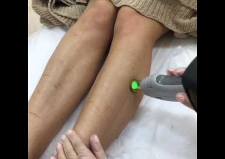 Лазерная эпиляция области голени ноги