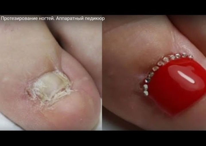 Протезирование ногтей. Аппаратный педикюр