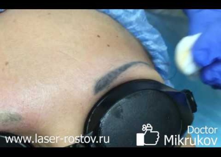 Позитивное удаление татуажа бровей неодимовым лазером