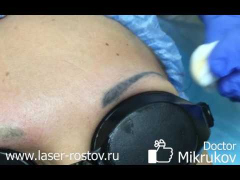 Позитивное удаление татуажа бровеи? неодимовым лазером